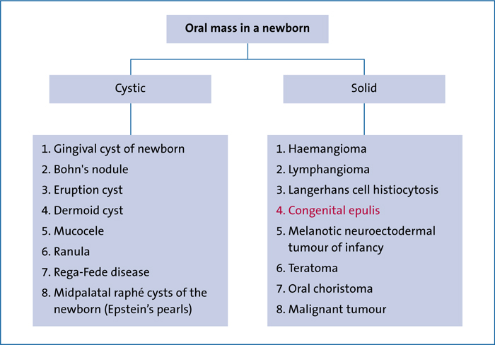 Gingival Cyst Of The Newborn